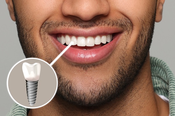 Tooth Replacement &# ; The Steps For A Dental Implant Procedure
